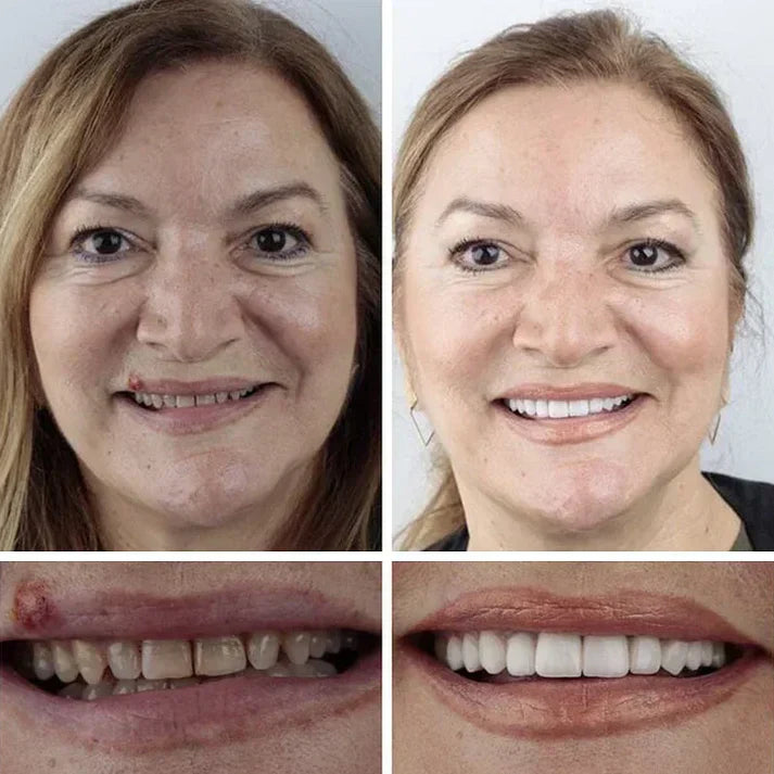 🏆2026 Bestselling🔥Product Fit for a FreshSmile, Say Goodbye to Wearing Discomfort!🌎