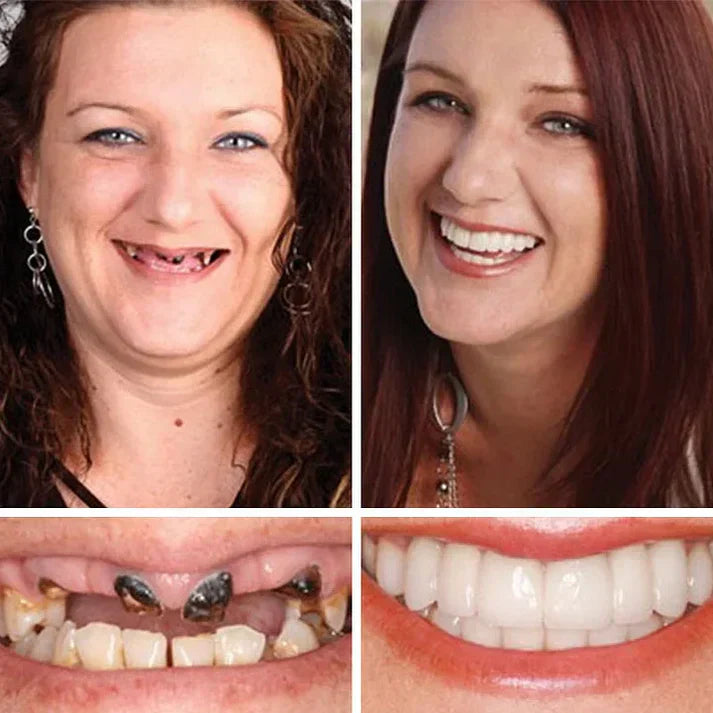 🏆2026 Bestselling🔥Product Fit for a FreshSmile, Say Goodbye to Wearing Discomfort!🌎