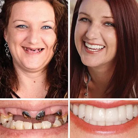 🔥 Custom-Fit Instant Smile Dentures – Natural Look & Comfort Fit | 50% OFF Today
