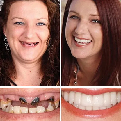 🔥 Custom-Fit Instant Smile Dentures – Natural Look & Comfort Fit | 50% OFF Today